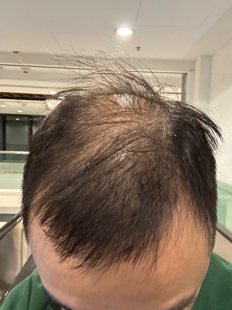 使用 DARKO 前的頭髮狀況